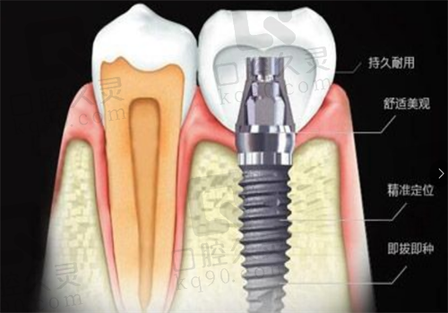 天津诺尔口腔医院种植牙图