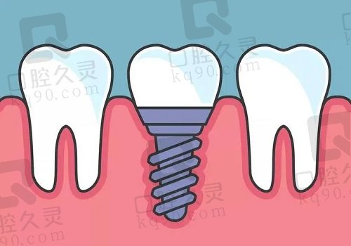 种植牙图片