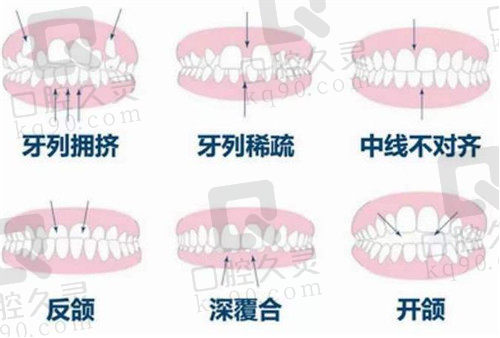 牙列不齐的种类