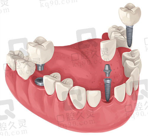 北京中诺口腔种植牙价格表