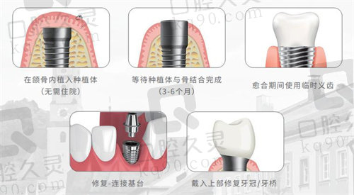 郑州中诺口腔种植牙价格表