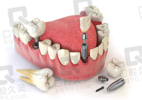 宁波前10种植牙医院收费参考