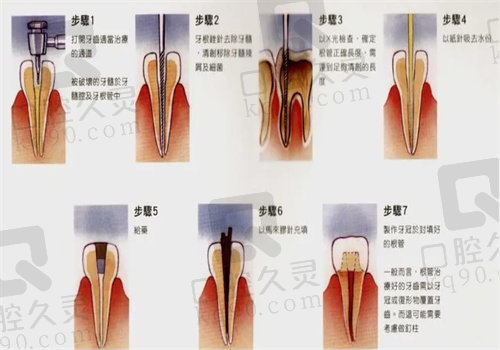 成都根管治疗图