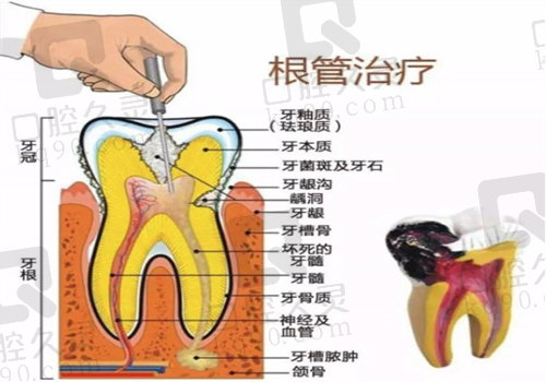 成都根管治疗图