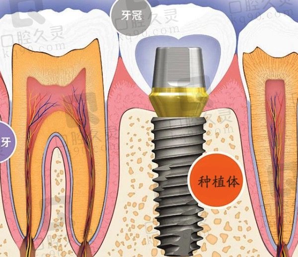 种植牙