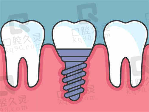 上海种植牙新价格指南