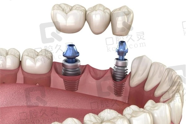 多颗种植牙