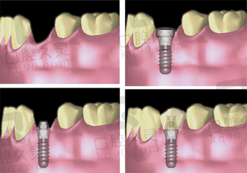 种植牙图