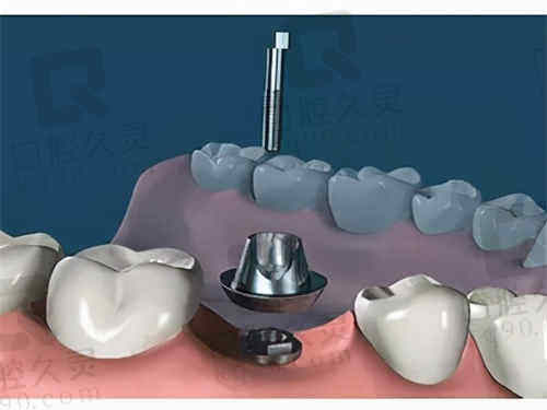 宁波江北牙科医院种植牙术后好的快
