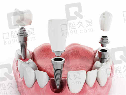 宁波江北牙科医院种植牙术后好的快