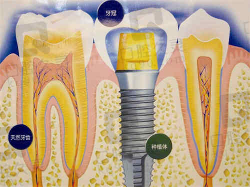 宁波宁海牙贝恩口腔的种植牙技术