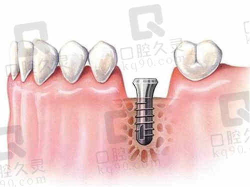 宁波宁海牙贝恩口腔的种植牙技术