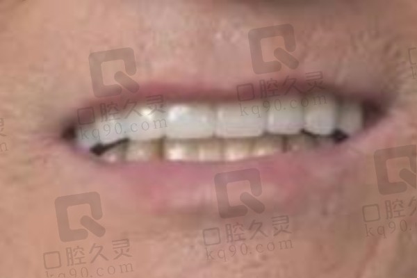 广州德伦口腔医院种植牙完成