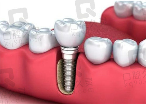 深圳格伦菲尔口腔医院种植牙好不好