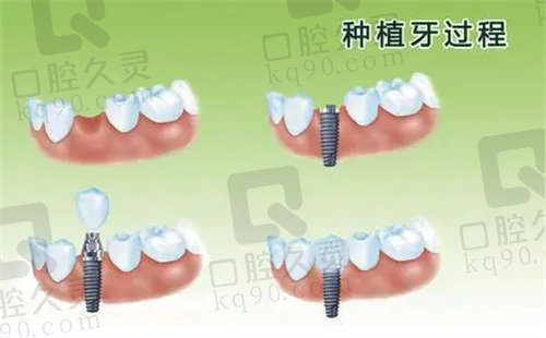 种植牙过程和步骤详情