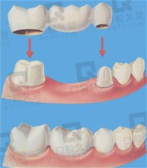 烤瓷牙修复过程