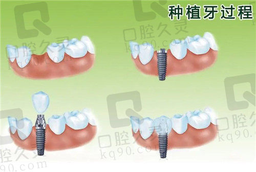 种植牙过程