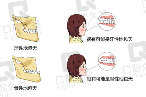 牙性地包天和骨性地包天的区别