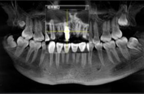 北京中诺口腔医院种植牙拍片