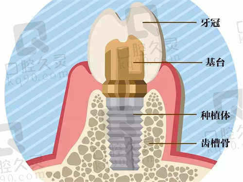 合肥崔劲松口腔种植牙技术怎么样