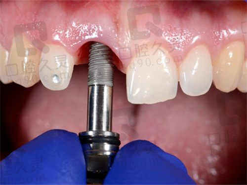 合肥崔劲松口腔种植牙技术怎么样