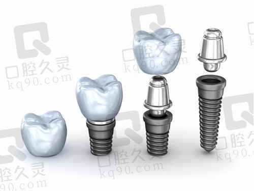 宁波恒美口腔种植牙价格表