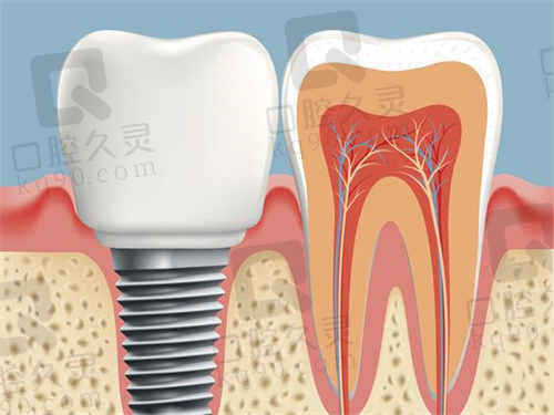 宁波恒美口腔种植牙价格表