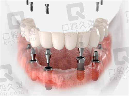 上海瑞伢美口腔牙齿种植价
