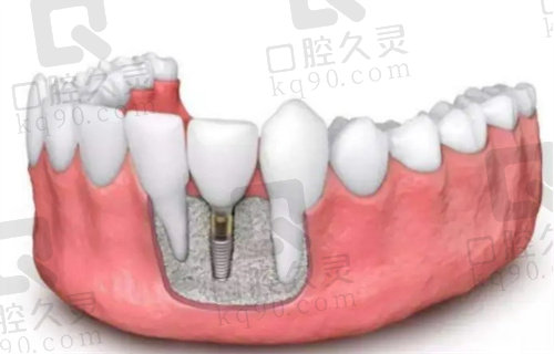 武汉大众口腔种植牙做的好