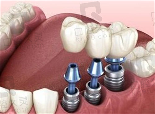 武汉大众口腔种植牙怎么样