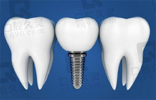 武汉大众口腔种植牙技术好