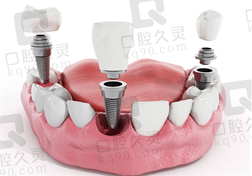 武汉德韩口腔医院种植牙
