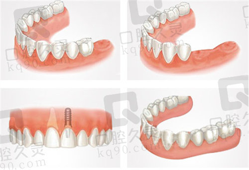 北京冠美平乐口腔种植牙过程