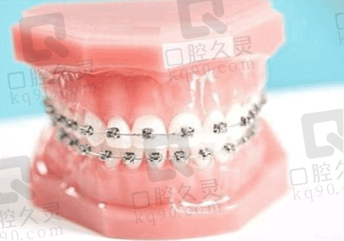 传统牙齿矫正器