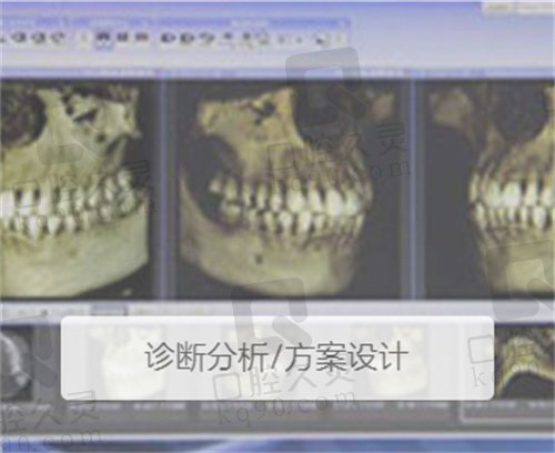 北京拜博口腔数字化种植牙设计