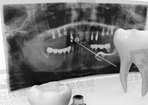青岛牙博士口腔医院种植牙检查