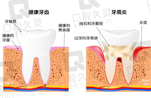 北京瑞泰口腔牙周炎