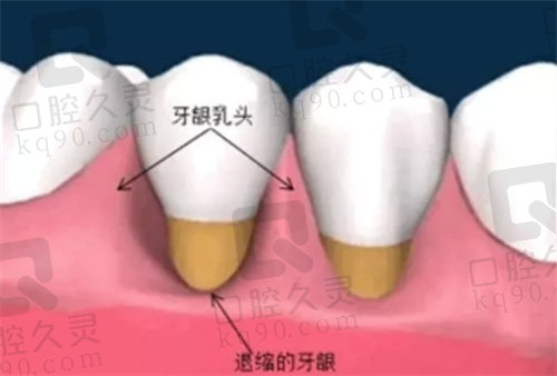 牙龈萎缩示意图