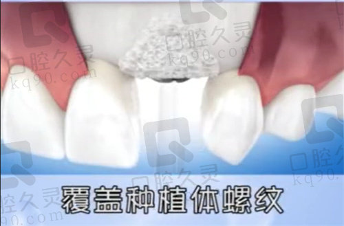 北京煤医西坝河口腔种植牙