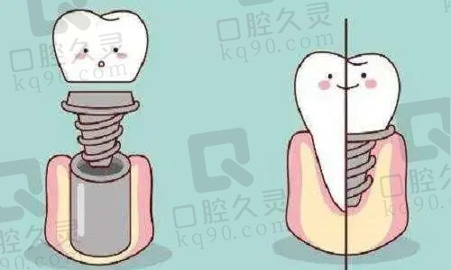 种植牙后注意事项大全