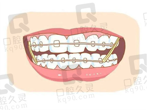 衡水可恩口腔来矫正牙齿