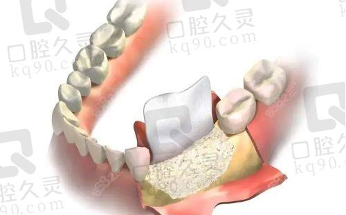 拔牙后牙槽骨会缩小吗?