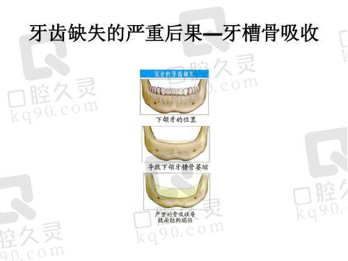 拔牙后牙槽骨会缩小吗?