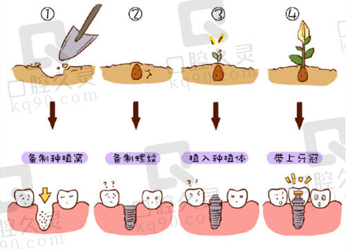 沛县楷博口腔种植牙