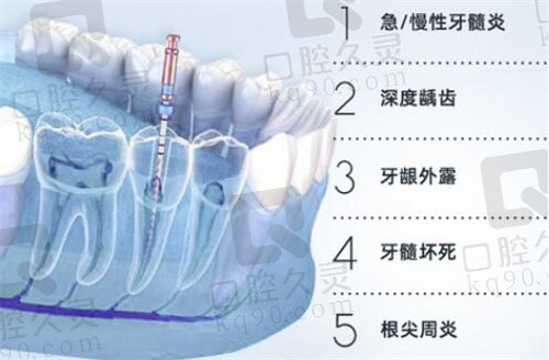 沛县魏氏口腔根管治疗