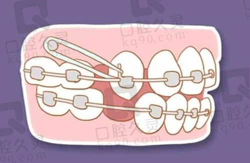 牙齿矫正示意图