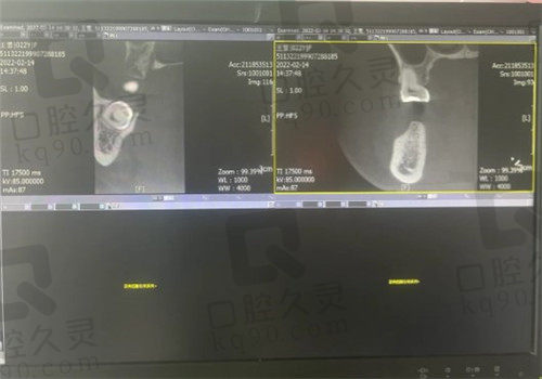 成都金牛极光口腔医院植牙前