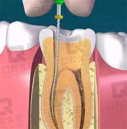 北京美呀口腔根管治疗