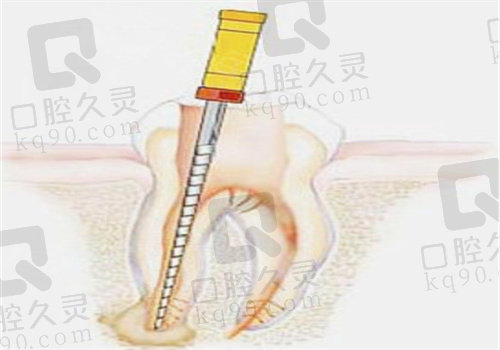 天津根管治疗图