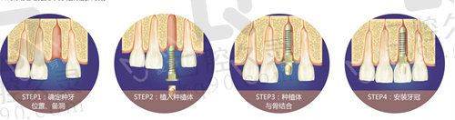 深圳新安麦芽口腔种植牙过程
